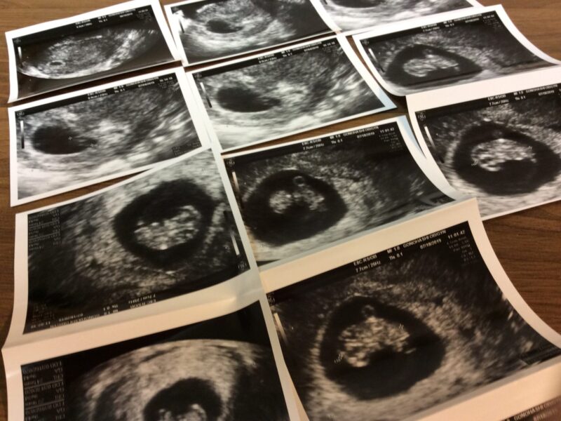 みやび鍼灸　エコー